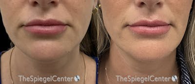 DOA Botulinum Before & After Gallery - Patient 210460 - Image 1