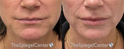 DOA Botulinum Before & After Gallery - Patient 414064 - Image 1