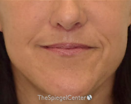 Ellacor Before & After Gallery - Patient 350044 - Image 2