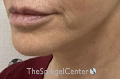 Ellacor Before & After Gallery - Patient 250358 - Image 3