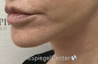 Ellacor Before & After Gallery - Patient 250358 - Image 4