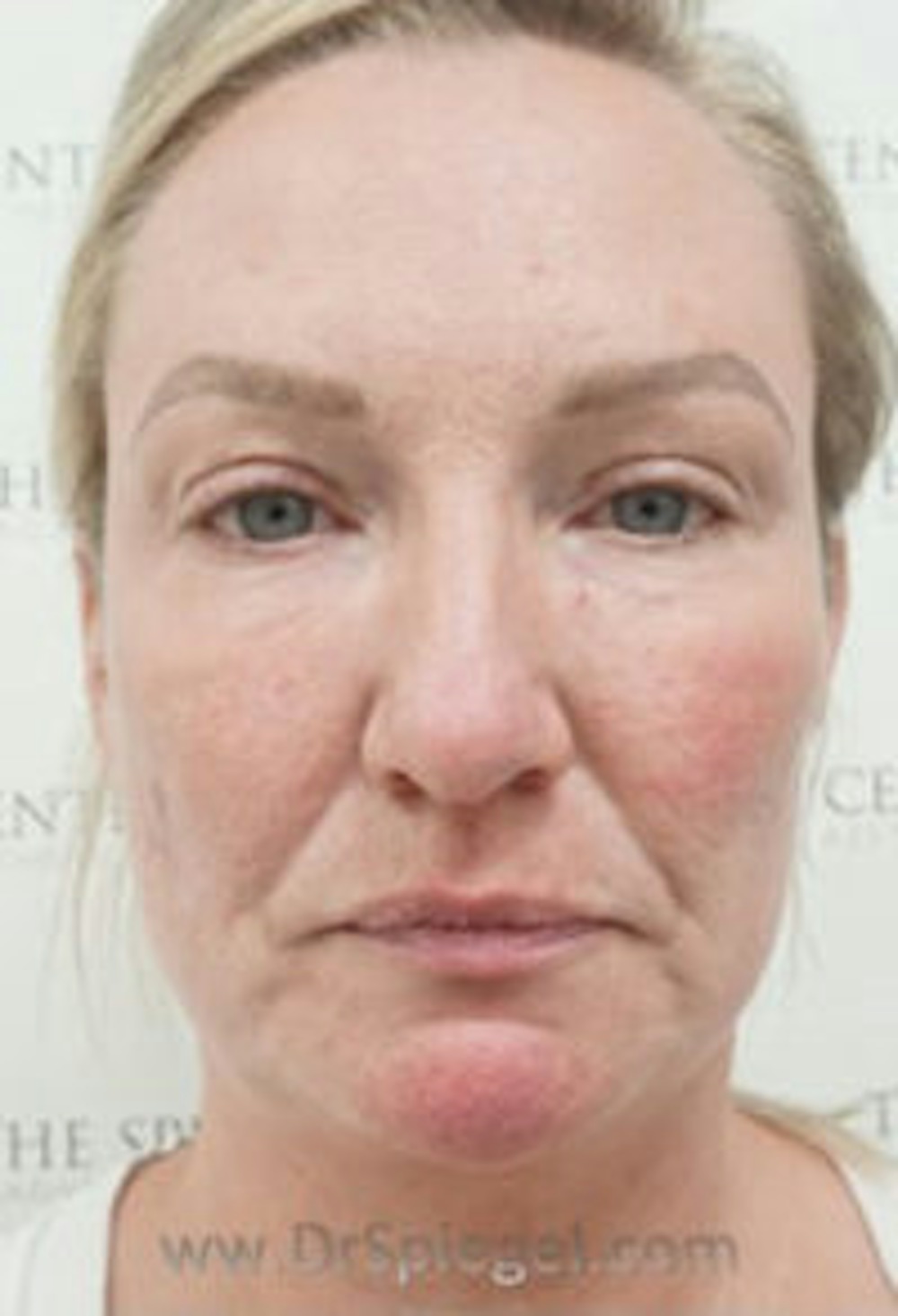 Facetite and Necktite