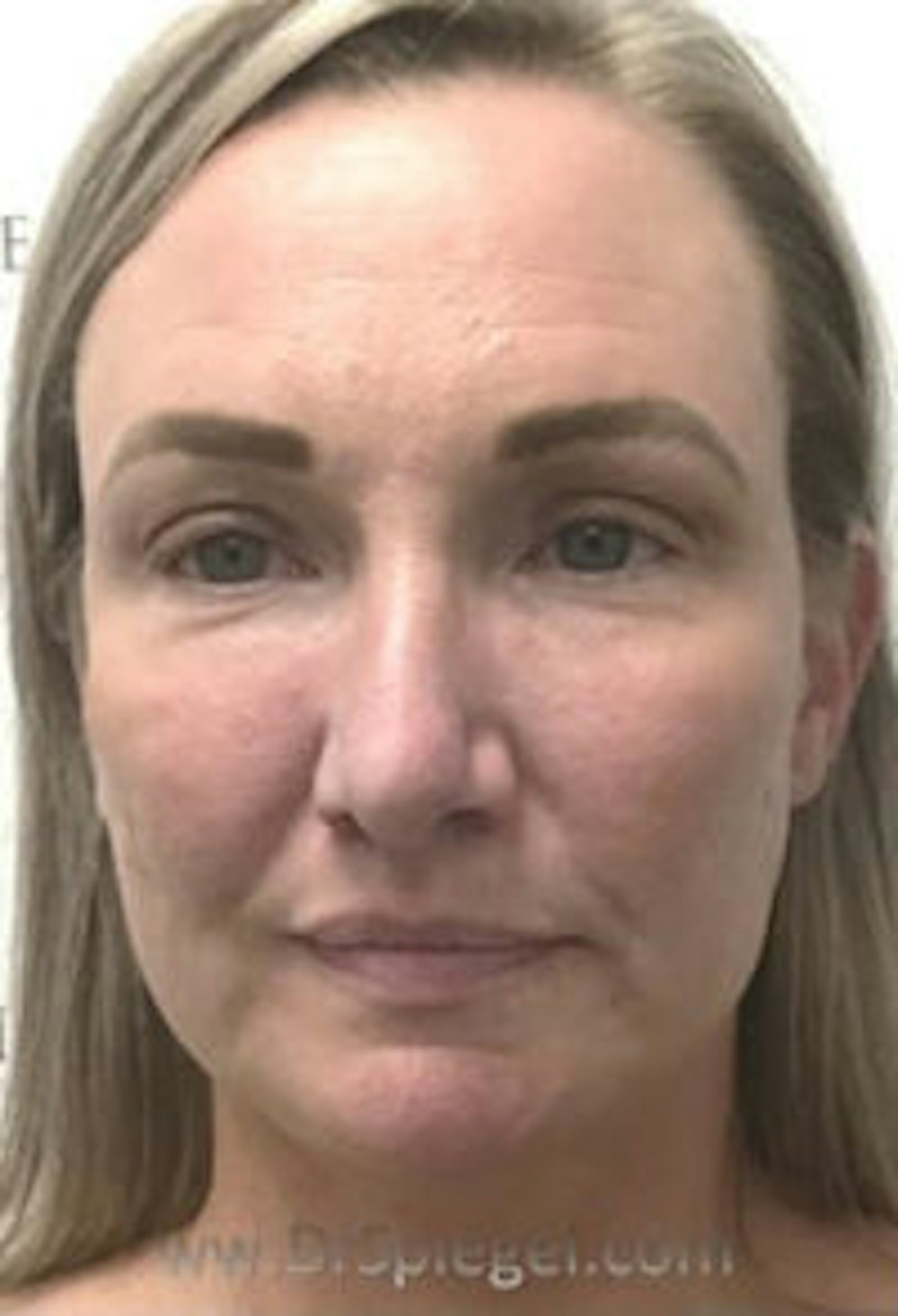 Facetite and Necktite