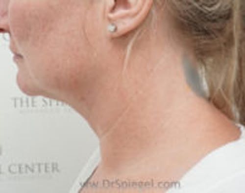 Facetite / Necktite / Embrace / Accutite Before & After Gallery - Patient 387415 - Image 5