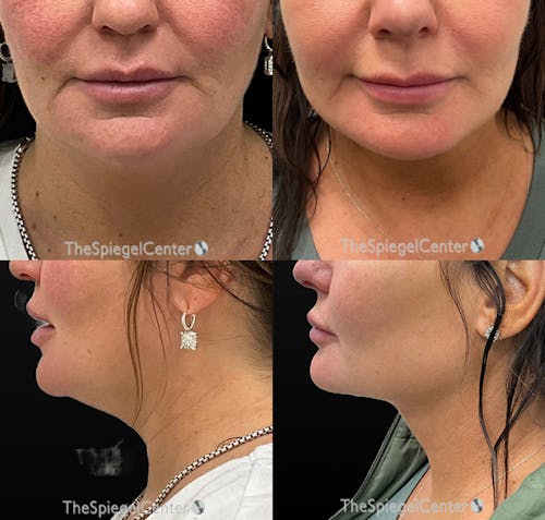 Facetite / Necktite / Embrace / Accutite Before & After Gallery - Patient 325113 - Image 1