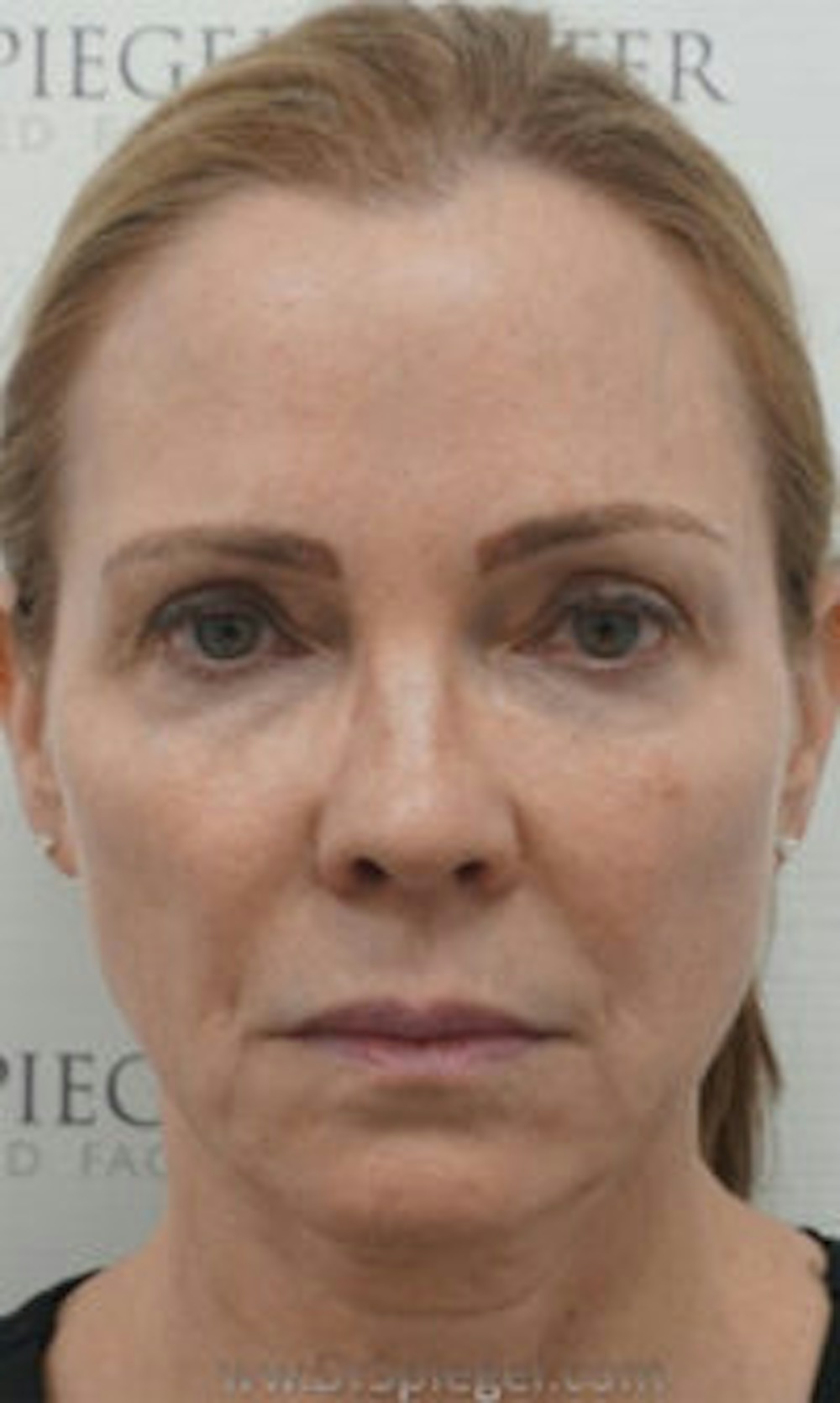 Facetite and Necktite