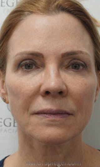 Facetite / Necktite / Embrace / Accutite Before & After Gallery - Patient 147286 - Image 2
