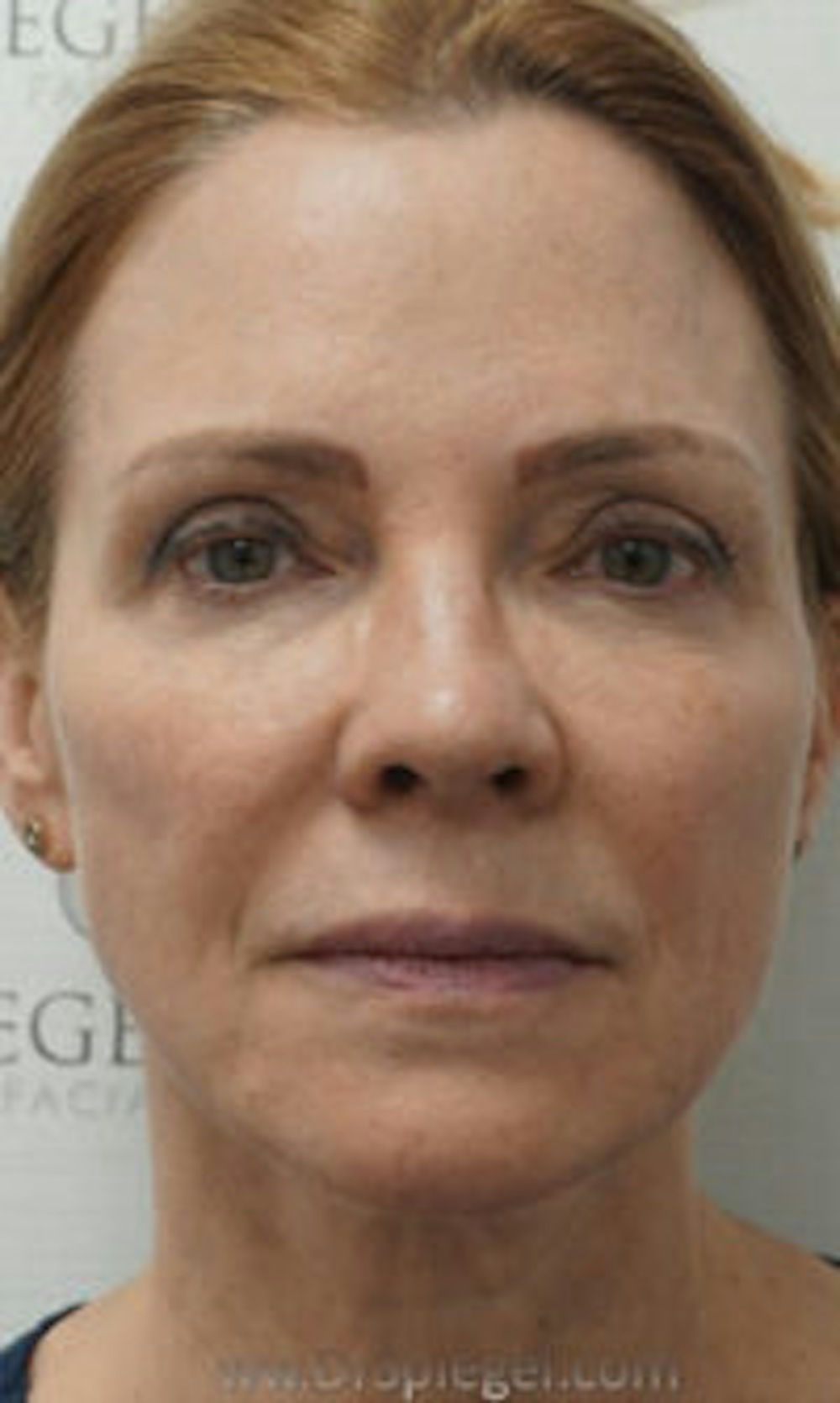 Facetite and Necktite