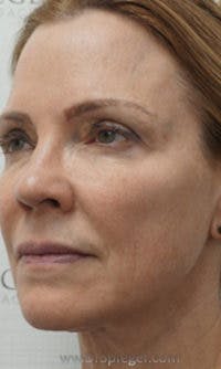 Facetite / Necktite / Embrace / Accutite Before & After Gallery - Patient 147286 - Image 4