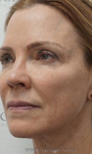 Facetite / Necktite / Embrace / Accutite Before & After Gallery - Patient 147286 - Image 4