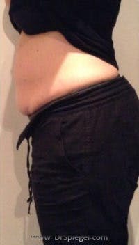 Fat Freezing Before & After Gallery - Patient 283349 - Image 2