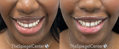 Gummy Smile Botox Before & After Gallery - Patient 132721 - Image 1