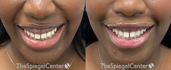 Gummy Smile Botox Before & After Gallery - Patient 132721 - Image 1
