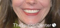 Gummy Smile Botox Before & After Gallery - Patient 228471 - Image 1