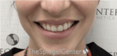 Gummy Smile Botox Before & After Gallery - Patient 310096 - Image 1