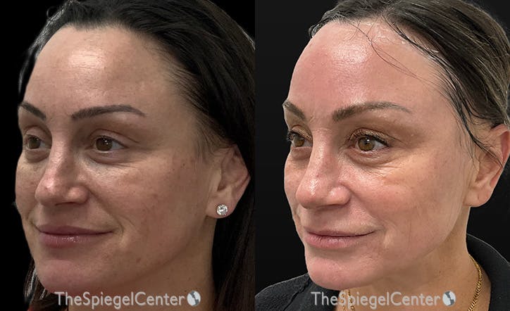 IPL / Intense Pulse Light Before & After Gallery - Patient 126539 - Image 1