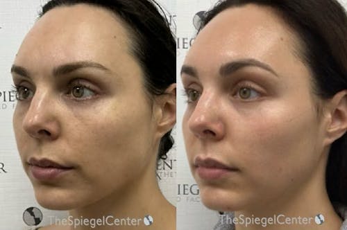IPL / Intense Pulse Light Before & After Gallery - Patient 780919 - Image 1