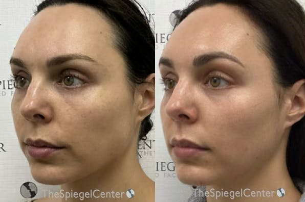 IPL / Intense Pulse Light Before & After Gallery - Patient 780919 - Image 1
