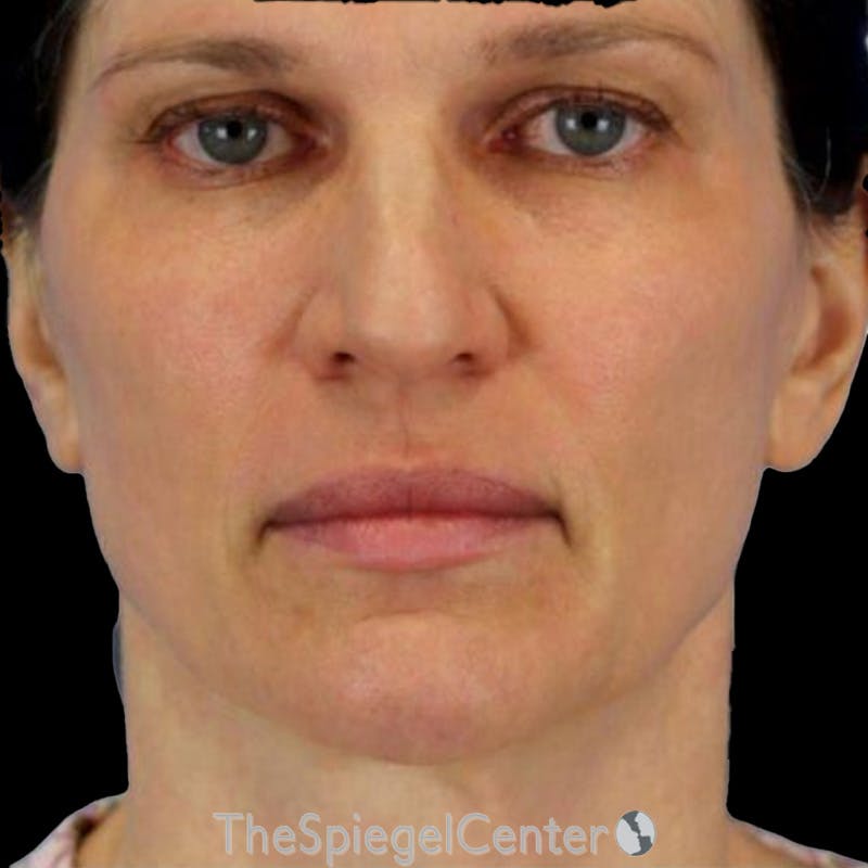 Junera (EraLift) Before & After Gallery - Patient 419181 - Image 1