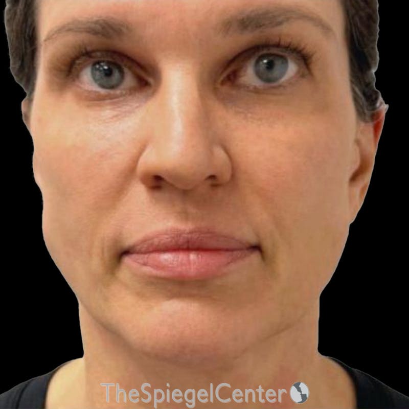 Junera (EraLift) Before & After Gallery - Patient 419181 - Image 2