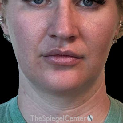 Junera (EraLift) Before & After Gallery - Patient 624672 - Image 1