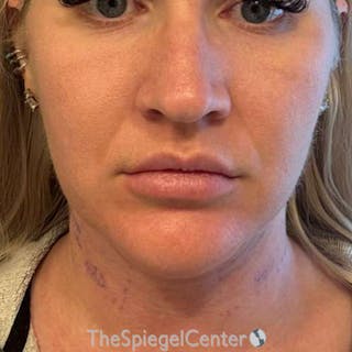 Junera (EraLift) Before & After Gallery - Patient 624672 - Image 2