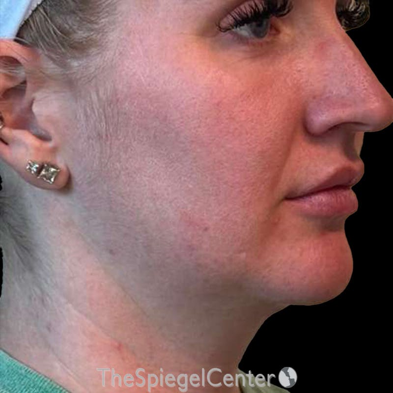 Junera (EraLift) Before & After Gallery - Patient 624672 - Image 3
