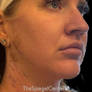 Junera (EraLift) Before & After Gallery - Patient 624672 - Image 4