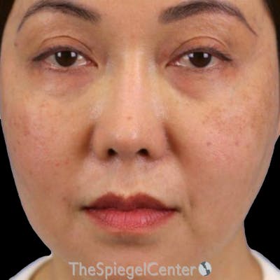Junera (EraLift) Before & After Gallery - Patient 863782 - Image 1
