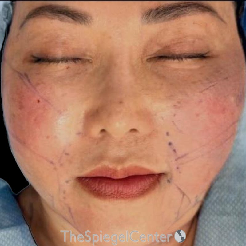 Junera (EraLift) Before & After Gallery - Patient 863782 - Image 2