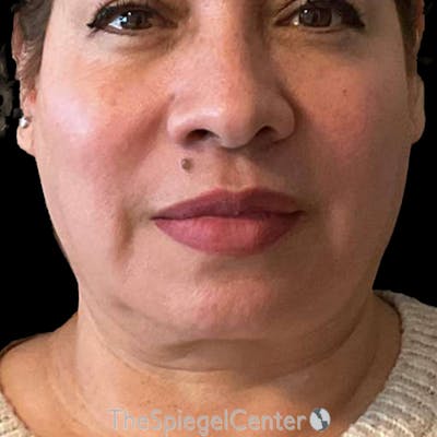 Junera (EraLift) Before & After Gallery - Patient 334968 - Image 1