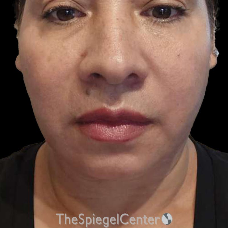 Junera (EraLift) Before & After Gallery - Patient 334968 - Image 2