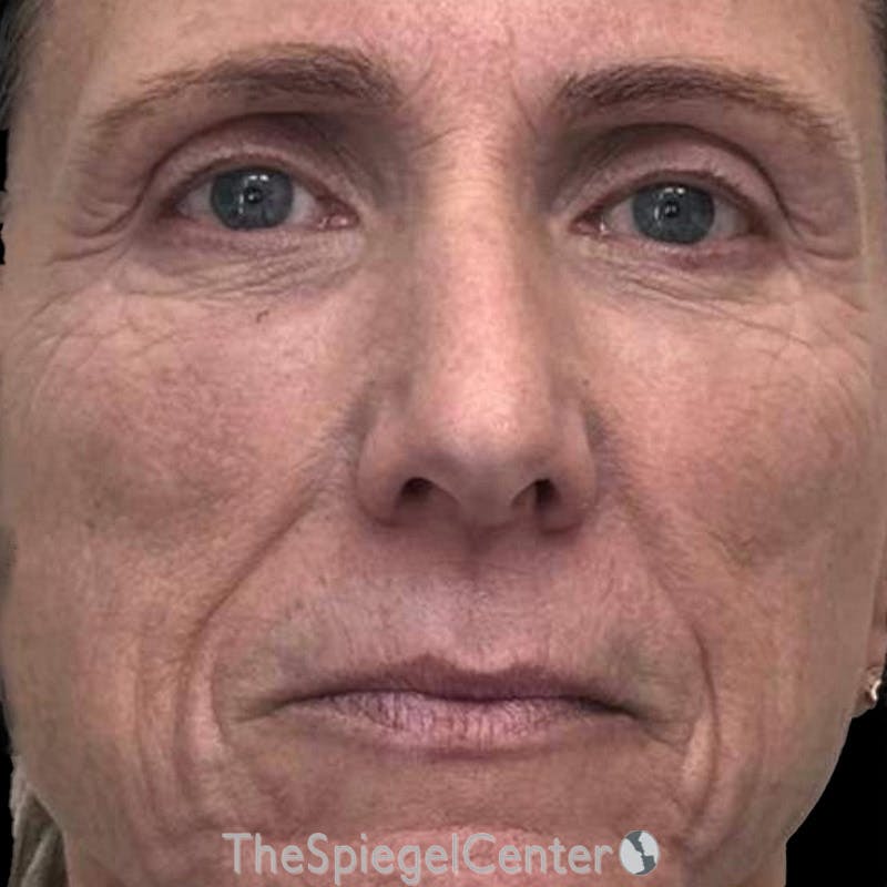 Junera (EraLift) Before & After Gallery - Patient 206611 - Image 1
