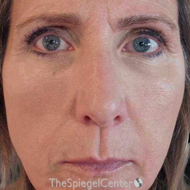 Junera (EraLift) Before & After Gallery - Patient 206611 - Image 2