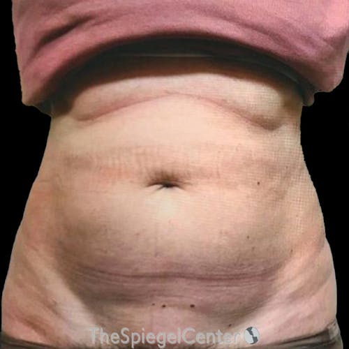 Junera Body Before & After Gallery - Patient 167048 - Image 1