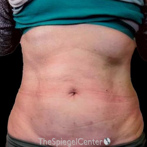 Junera Body Before & After Gallery - Patient 167048 - Image 2