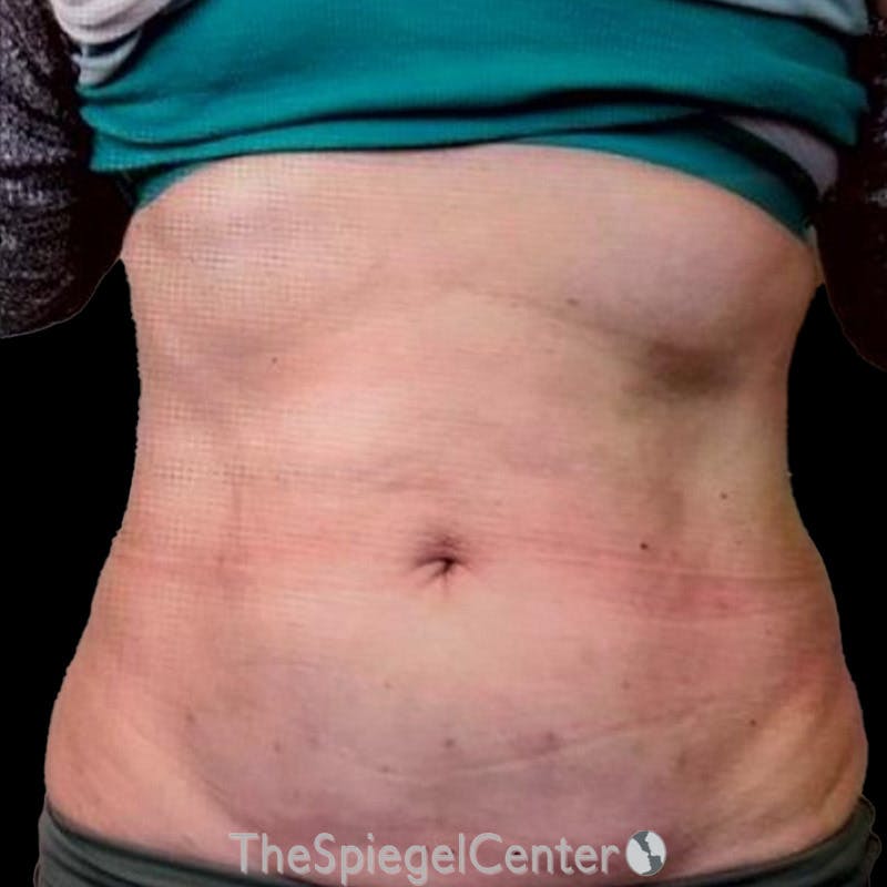 Junera Body Before & After Gallery - Patient 167048 - Image 2