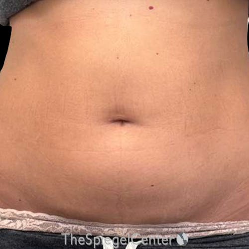 Junera Body Before & After Gallery - Patient 329362 - Image 1