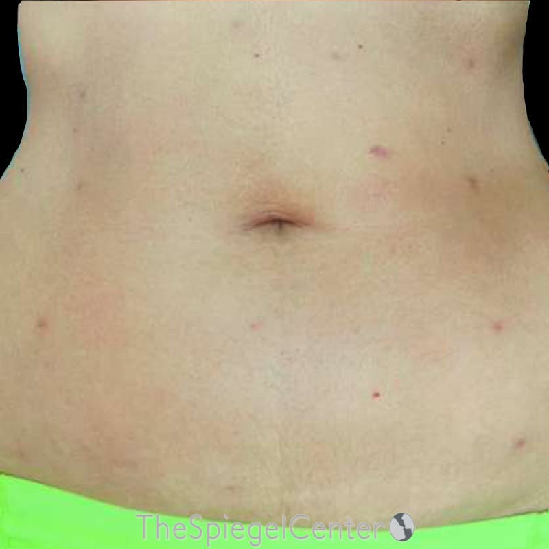 Junera Body Before & After Gallery - Patient 329362 - Image 2