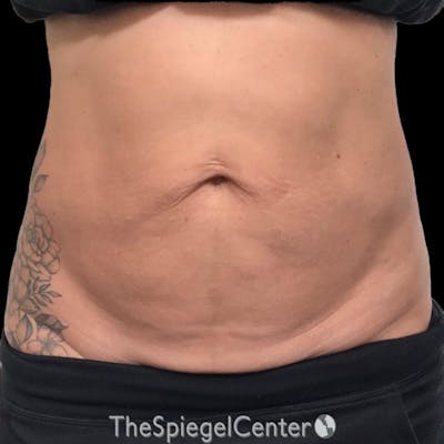 Junera Body Before & After Gallery - Patient 246758 - Image 1