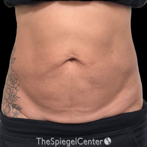 Junera Body Before & After Gallery - Patient 246758 - Image 1