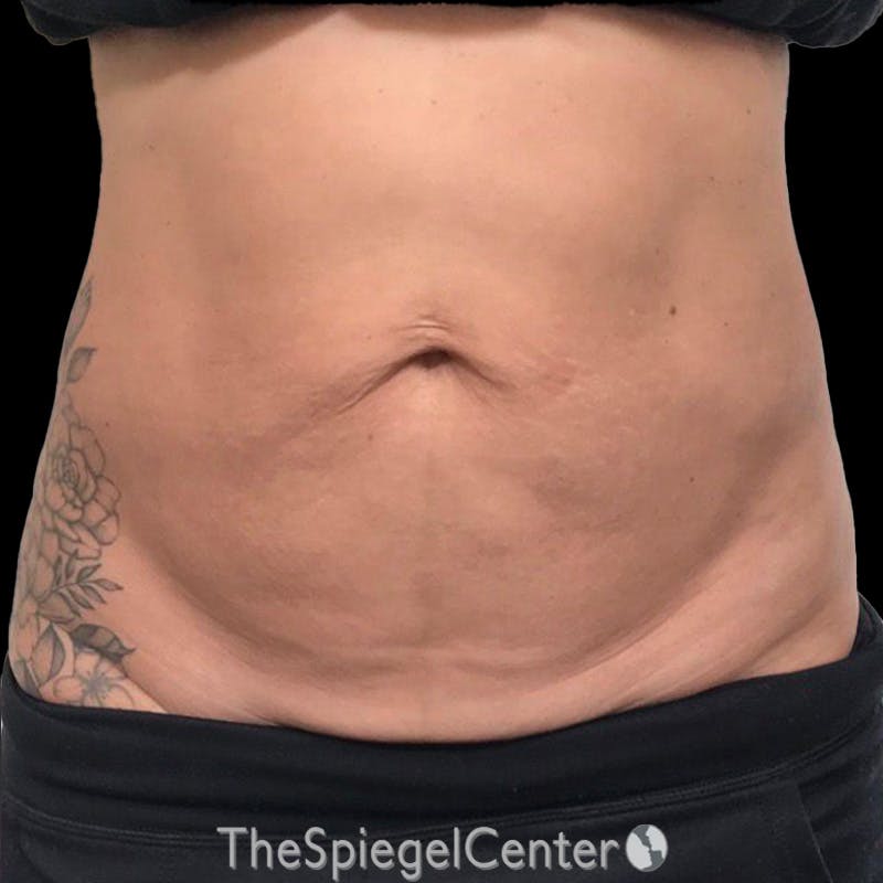 Junera Body Before & After Gallery - Patient 246758 - Image 1