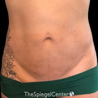Junera Body Before & After Gallery - Patient 246758 - Image 2