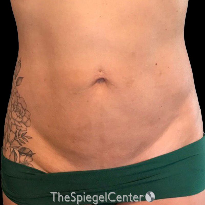 Junera Body Before & After Gallery - Patient 246758 - Image 2