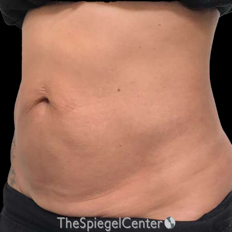 Junera Body Before & After Gallery - Patient 246758 - Image 3