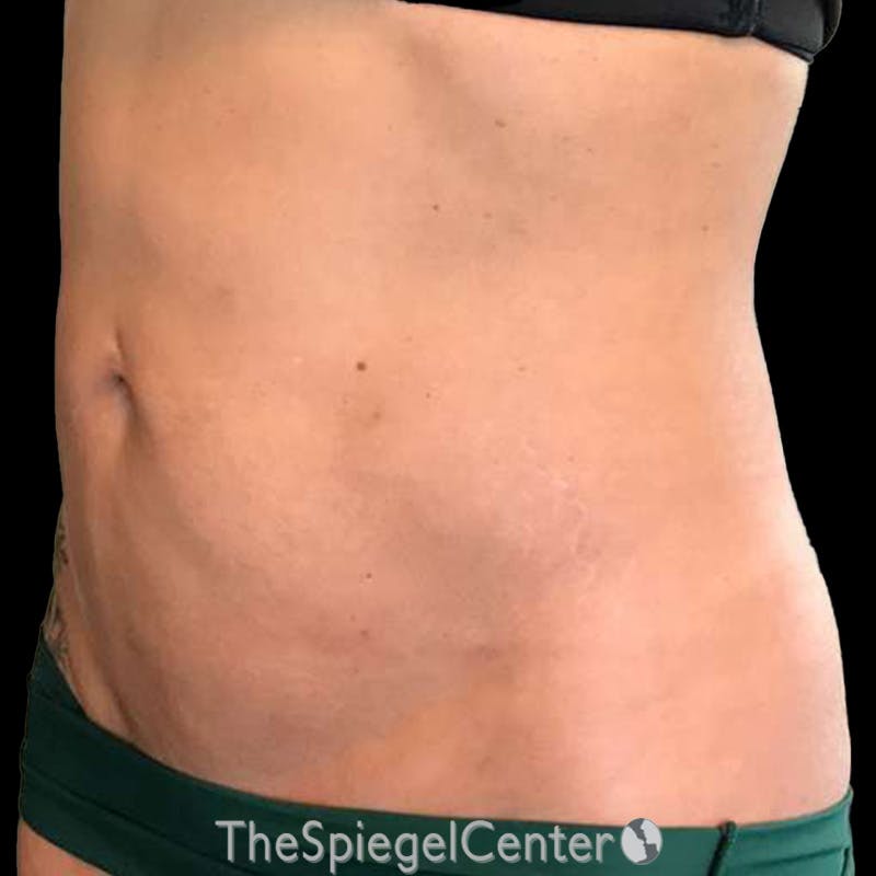 Junera Body Before & After Gallery - Patient 246758 - Image 4