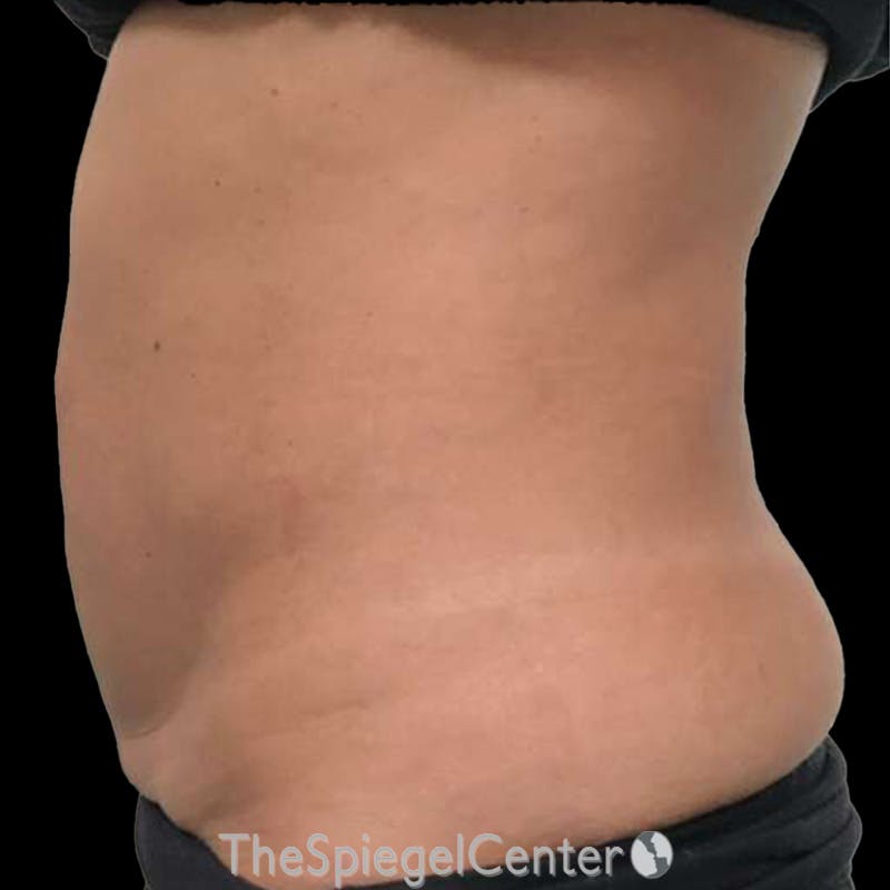 Junera Body Before & After Gallery - Patient 451355 - Image 1