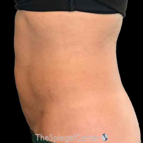 Junera Body Before & After Gallery - Patient 451355 - Image 2