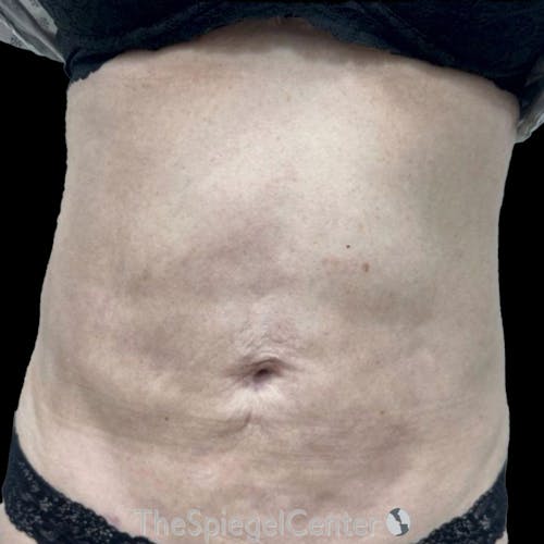 Junera Body Before & After Gallery - Patient 207736 - Image 1