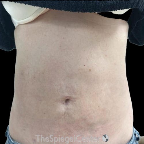 Junera Body Before & After Gallery - Patient 207736 - Image 2